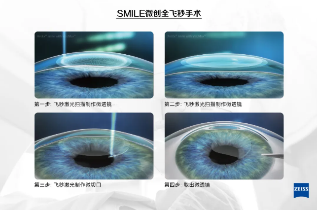 全飛秒激光SMILE