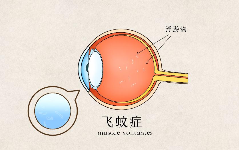 飛蚊癥