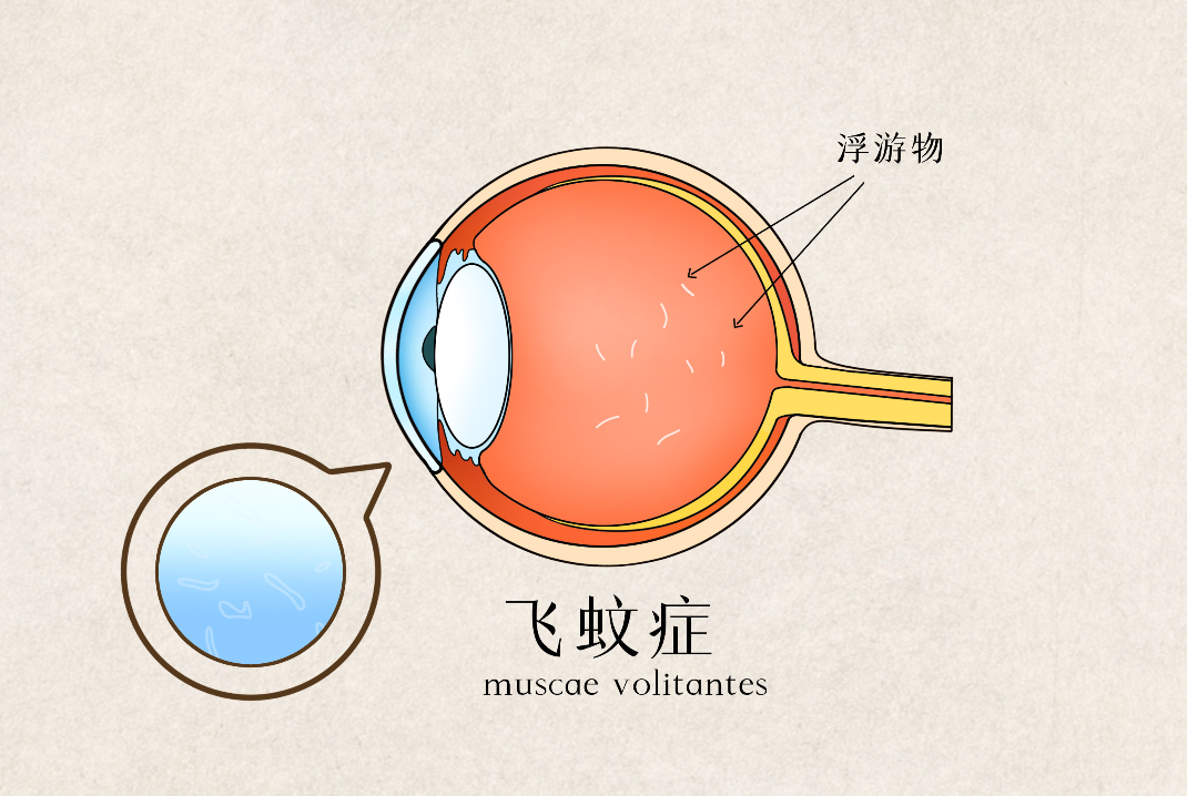 得了飛蚊癥怎么辦