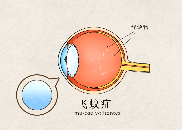 近視飛蚊癥
