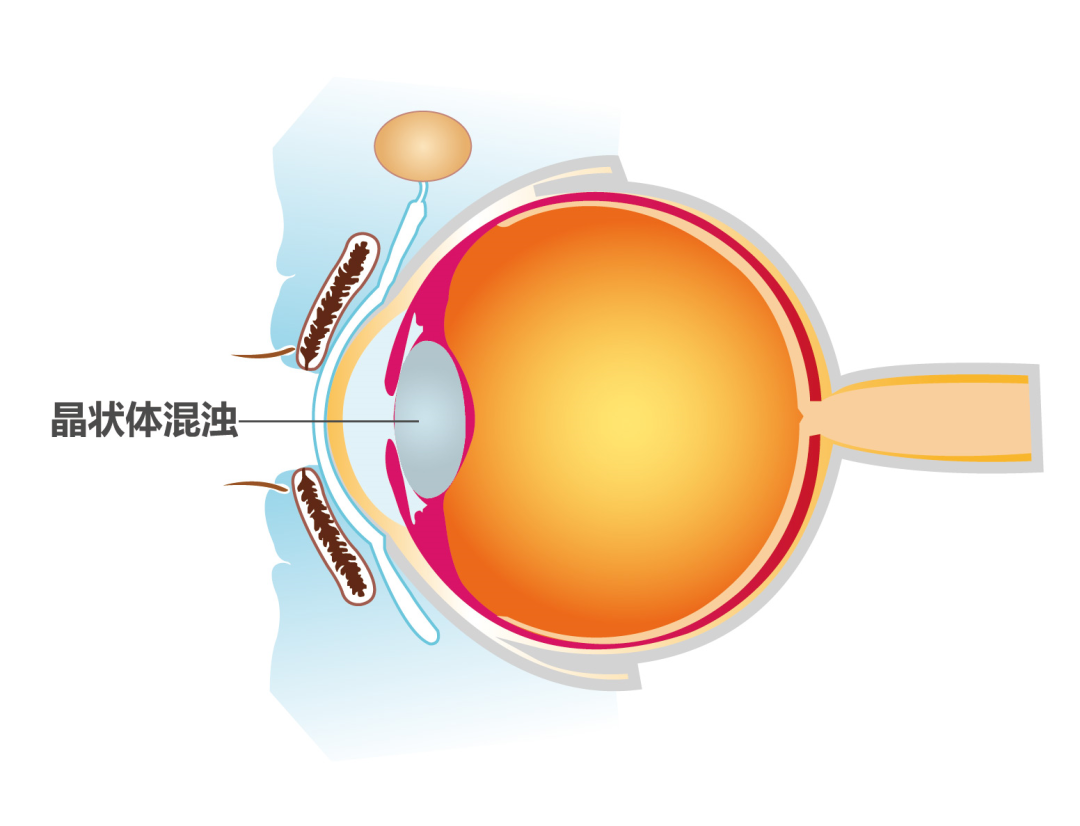 白內(nèi)障癥狀