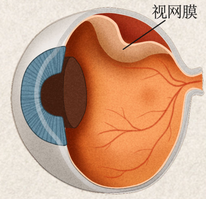 視網膜脫離